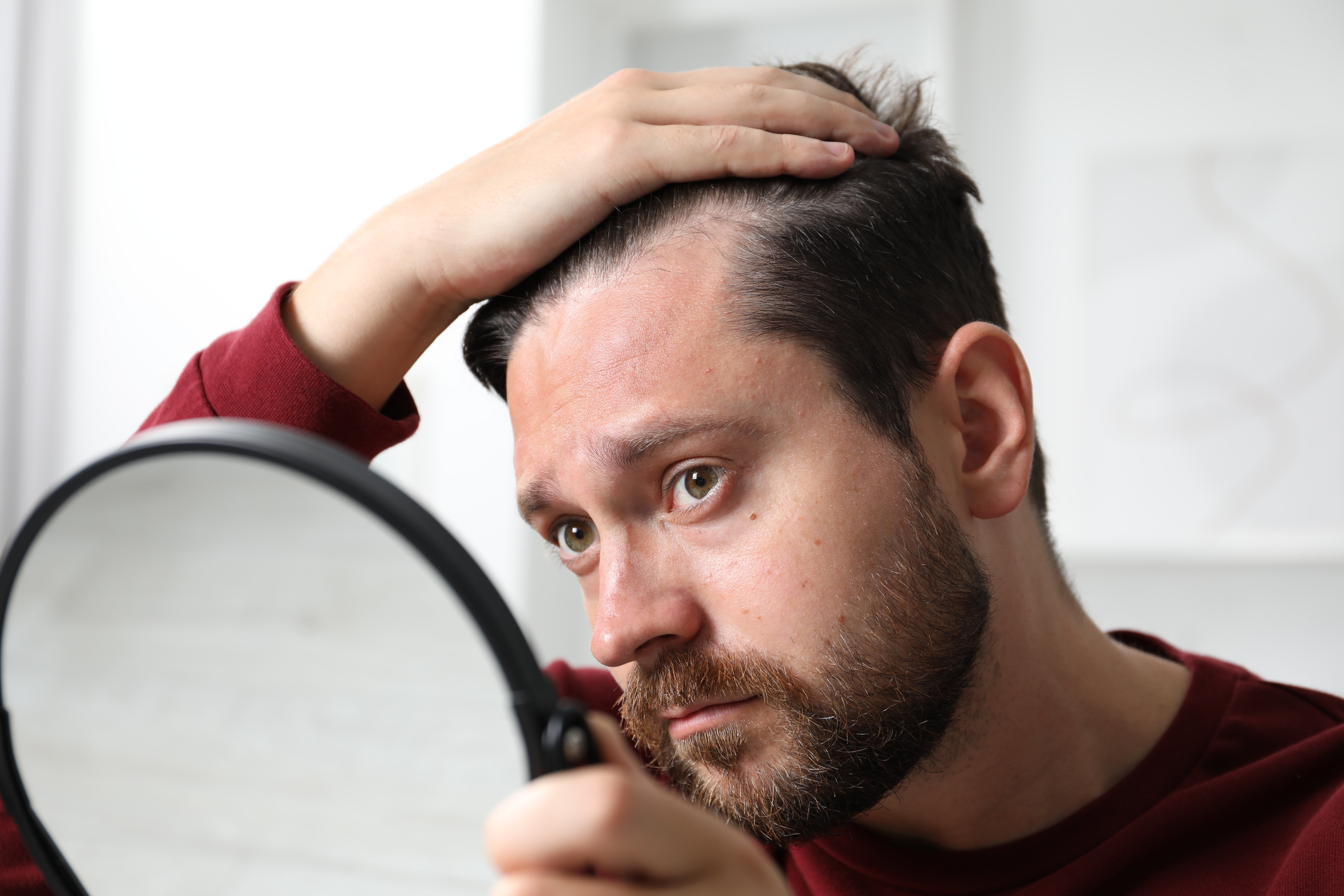 causas de la calvicie en hombres​